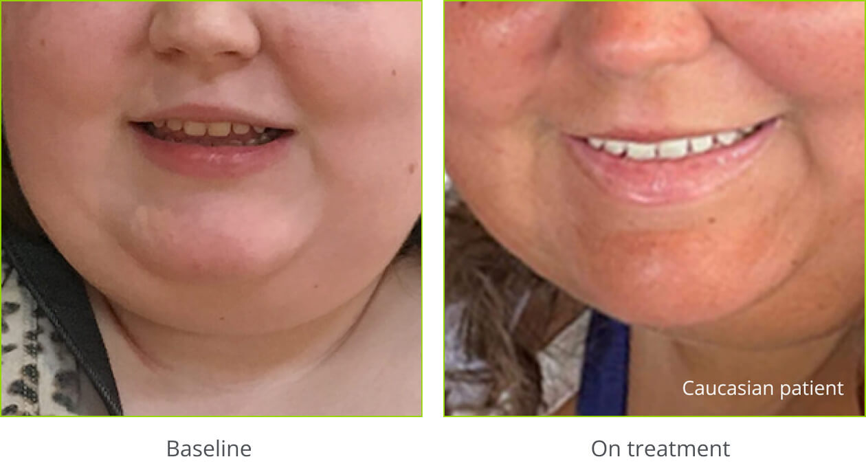 Example of hyperpigmentation
