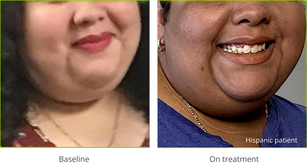 Example of hyperpigmentation