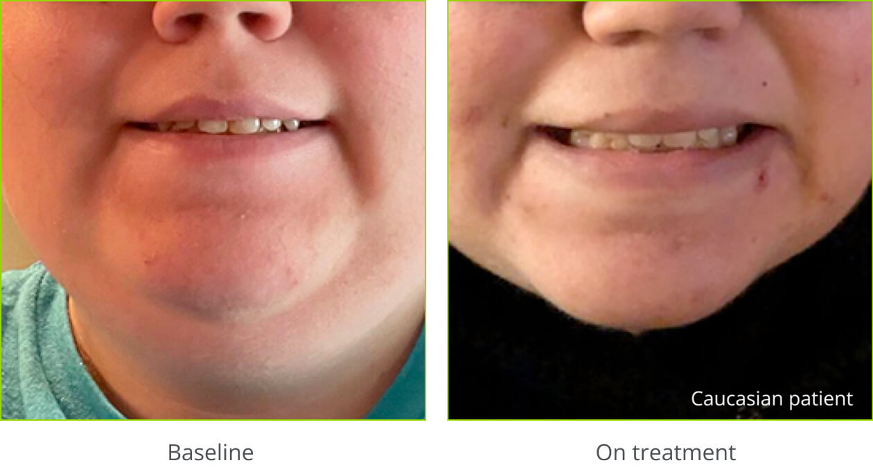 Example of hyperpigmentation